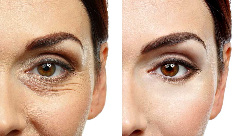 How To Tighten Skin Under Eyes Quickly Full Guide Alma Lasers