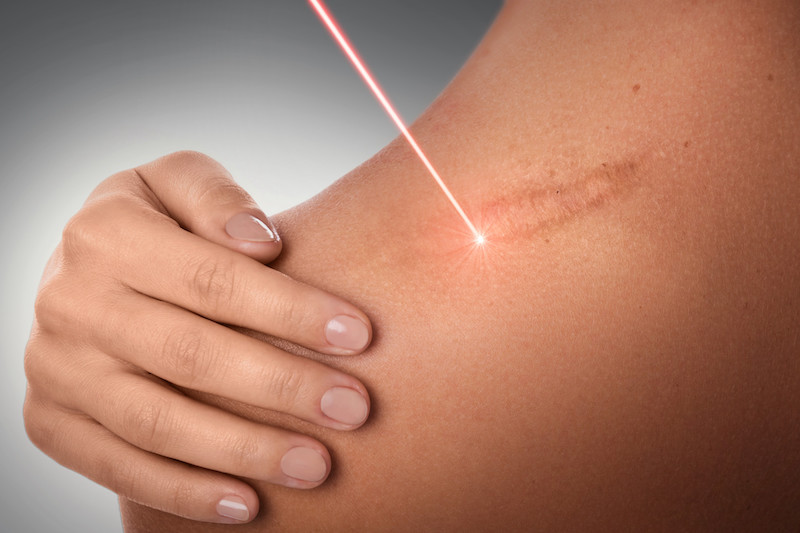 Laser scar removal treatment