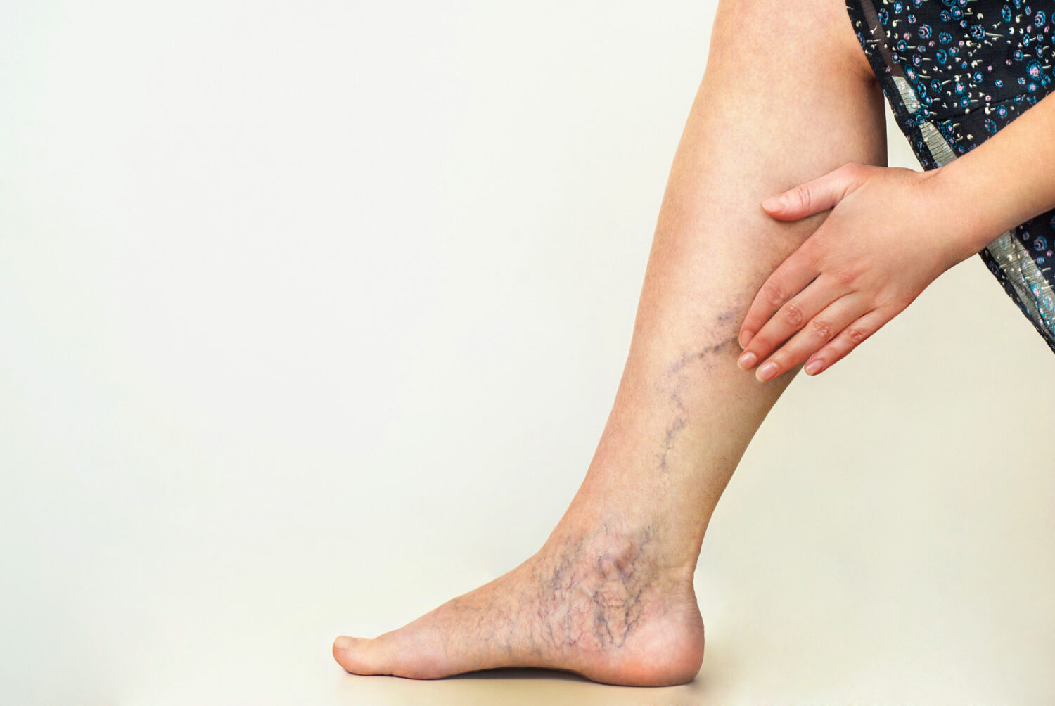 Laser Therapy: Is It the Best Treatment for Varicose Veins?