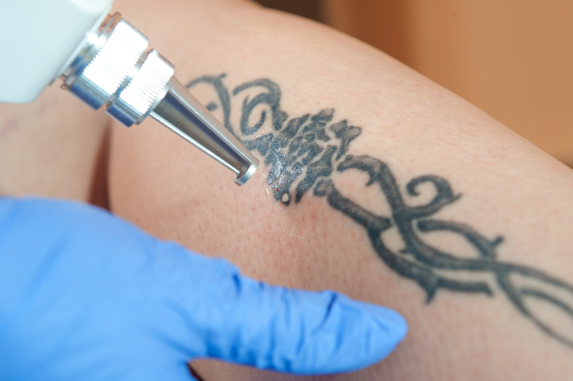Tattoo Removal Methods: What Works?