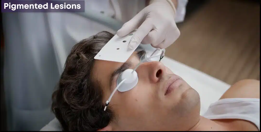 Alma Lasers Pigmentation Removal Laser