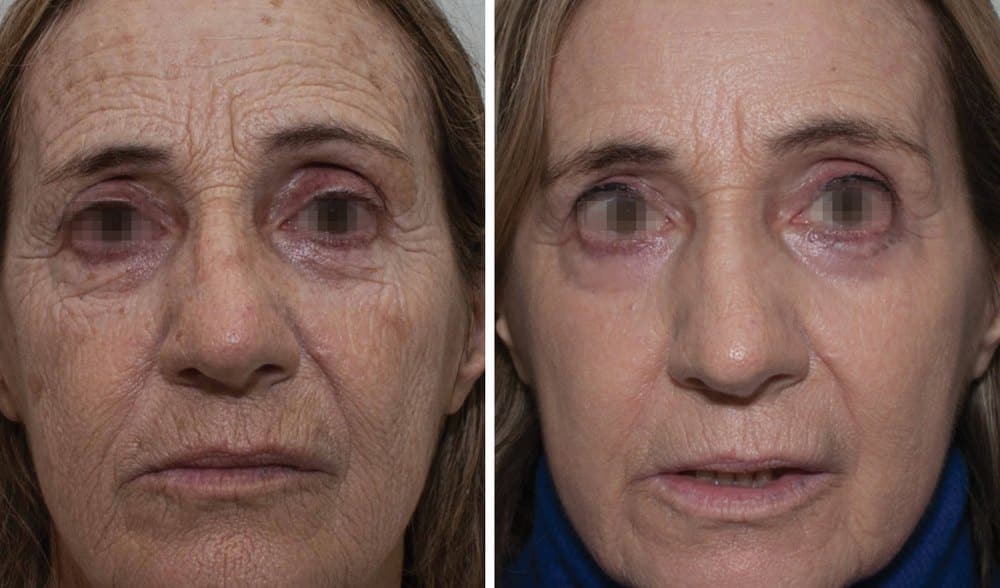 Facial resurfacing with Alma Pixel CO2, before and after, front view, courtesy of Dr Guillermo Badaracco