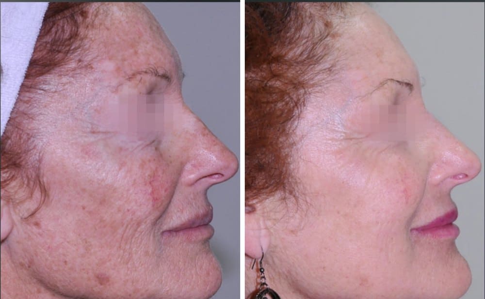 Facial resurfacing with Alma Pixel CO2, before and after, profile view, courtesy of Dr Guillermo Badaracco