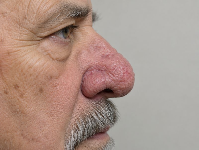 Rhinophyma treated with a CO2 laser in general practice