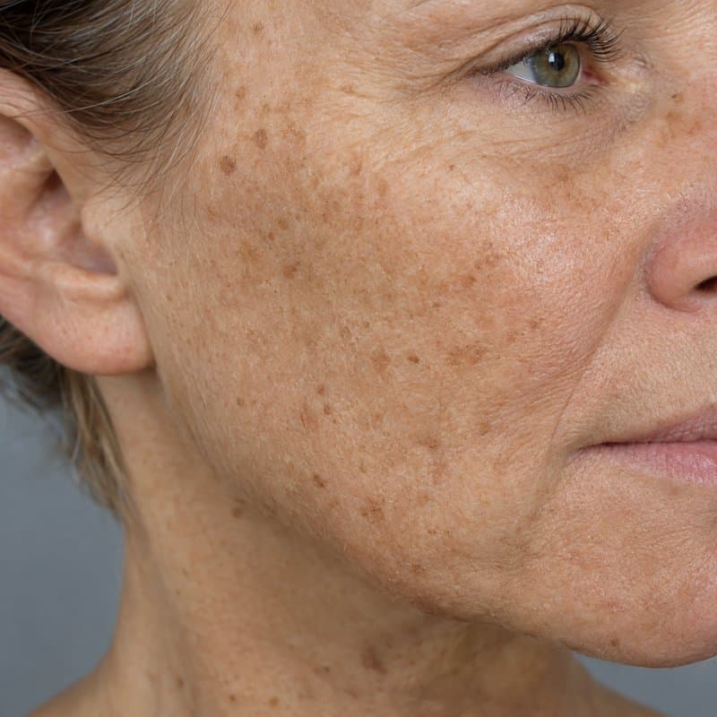 Ageing and sun-damaged facial skin with uneven tone and texture