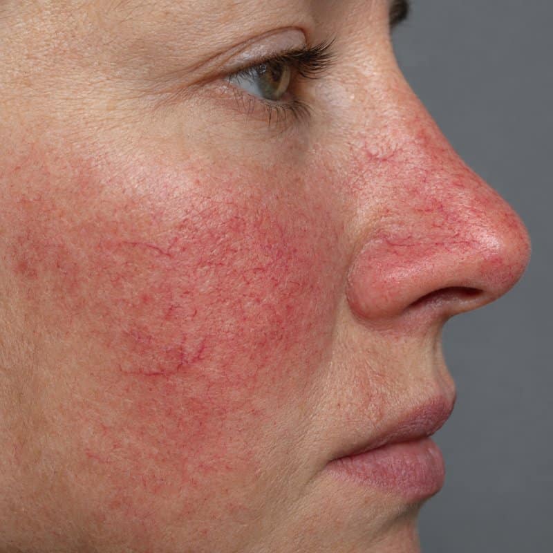 Fine red broken capillaries and diffuse facial redness, a vascular lesion treated with IPL