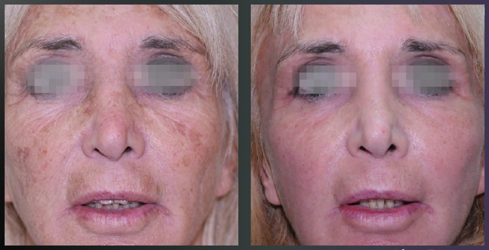 Before and after Alma Pixel CO2 skin rejuvenation, front view. Courtesy of Dr Guillermo Badaracco.