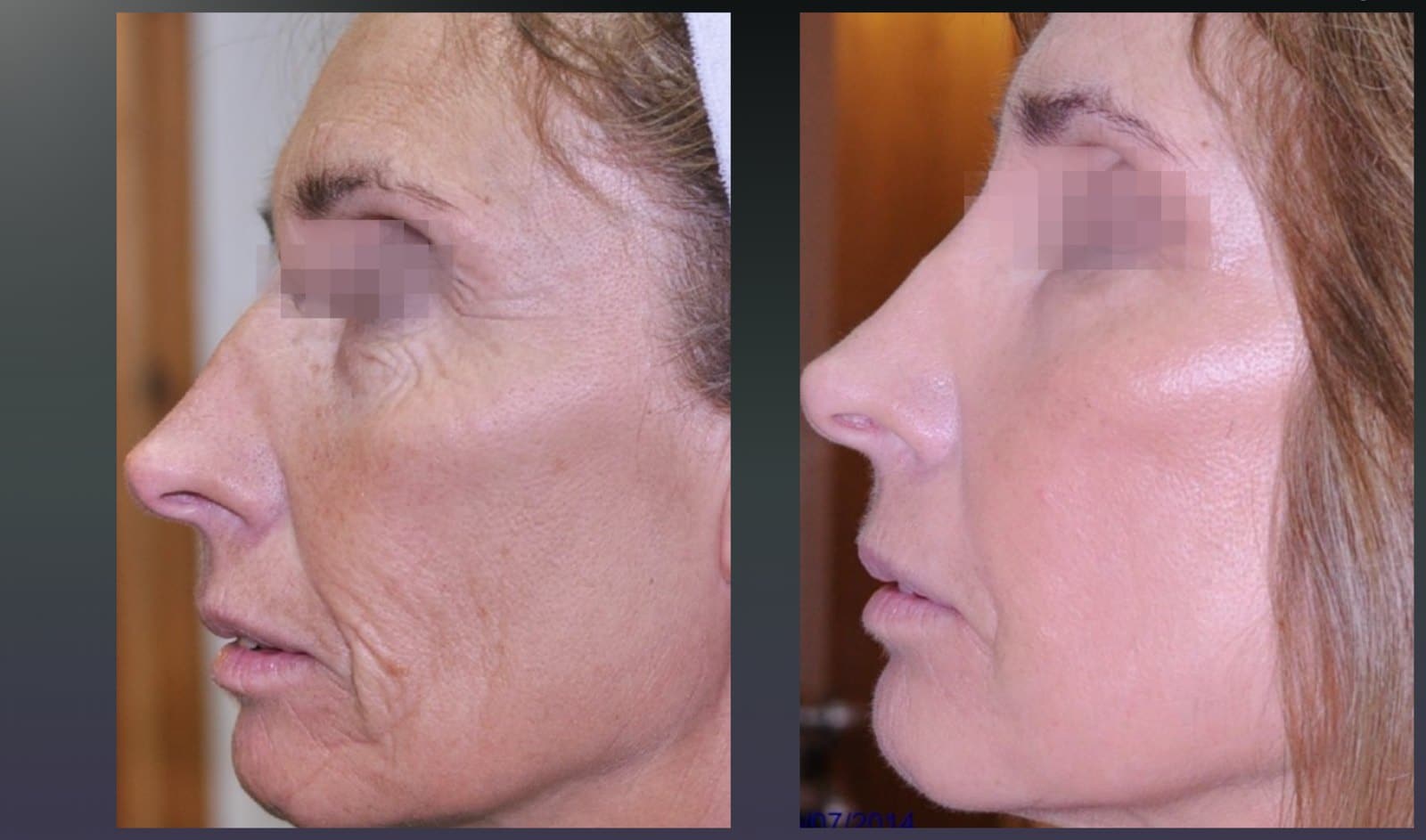 Before and after Alma Pixel CO2 skin rejuvenation, profile view. Courtesy of Dr Guillermo Badaracco.
