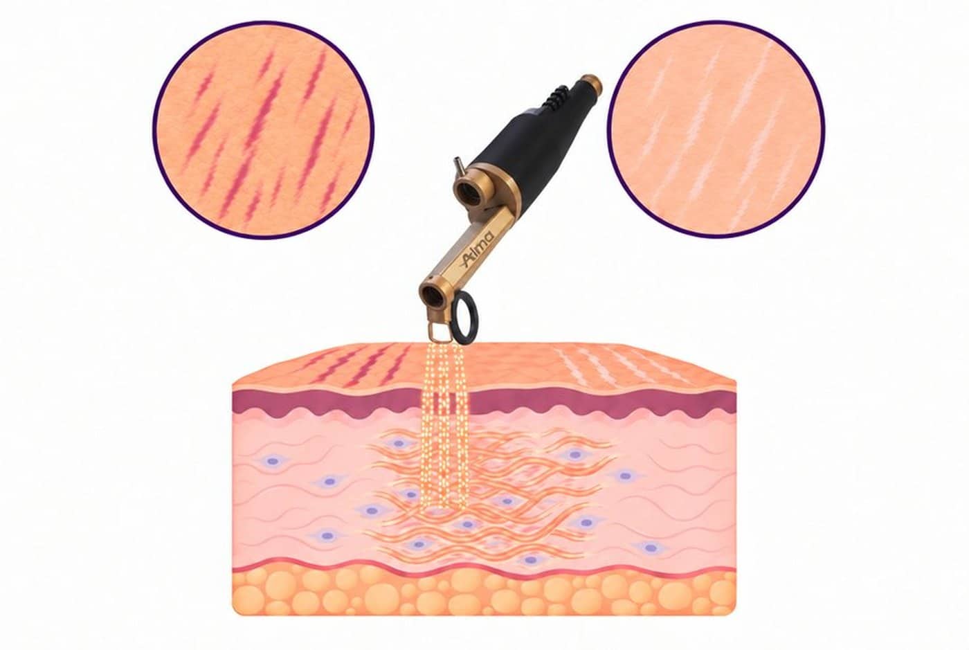 Recent red and older white stretch marks, and how a fractional laser rebuilds collagen beneath them