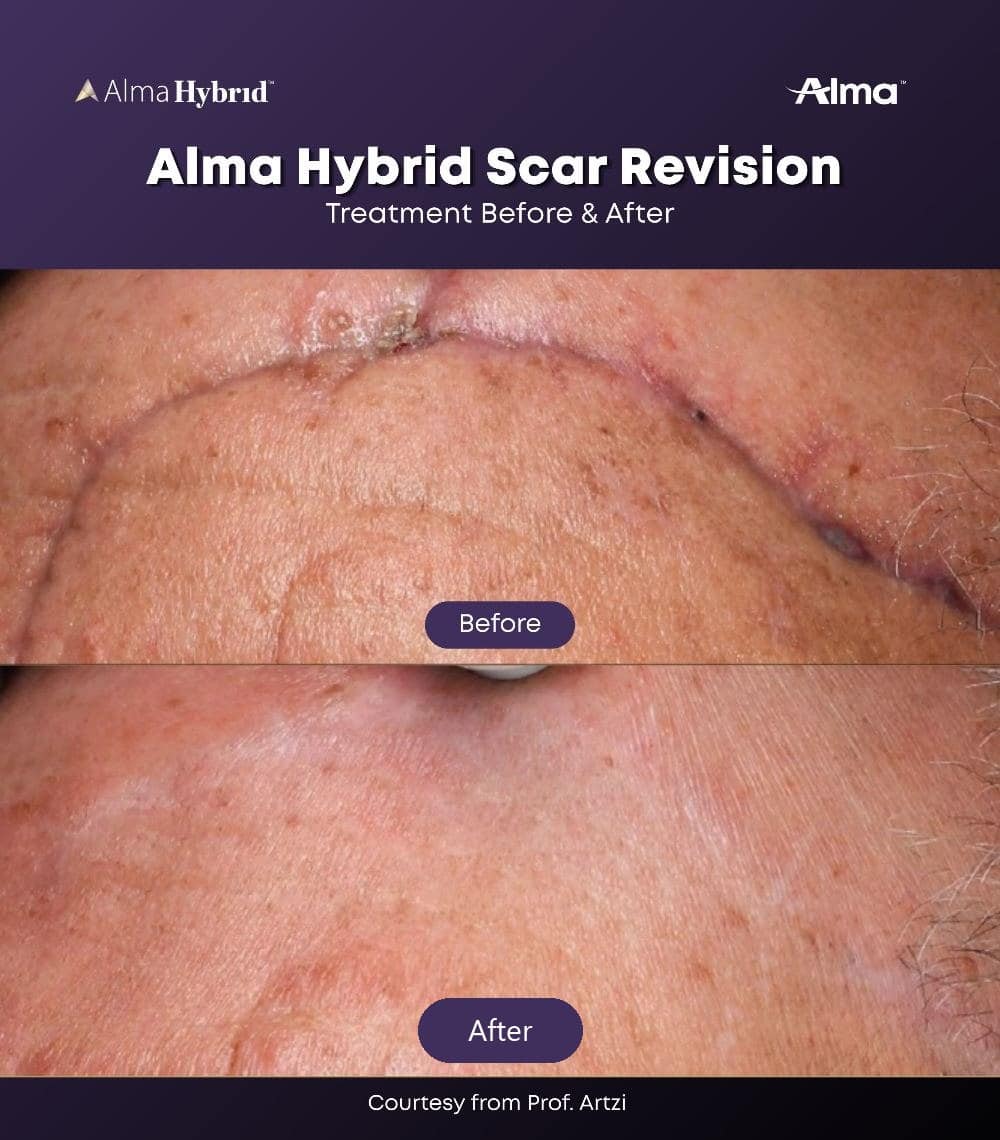 Surgical scar before and after Alma Hybrid scar revision, courtesy of Prof. Ofir Artzi; individual results vary