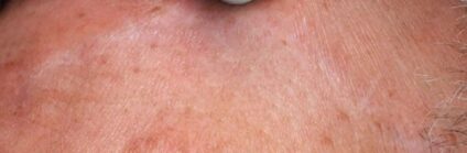 Surgical scar after a course of Alma Hybrid scar revision, courtesy of Prof. Ofir Artzi; individual results vary