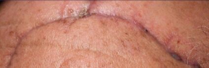 Surgical scar before Alma Hybrid scar revision, courtesy of Prof. Ofir Artzi