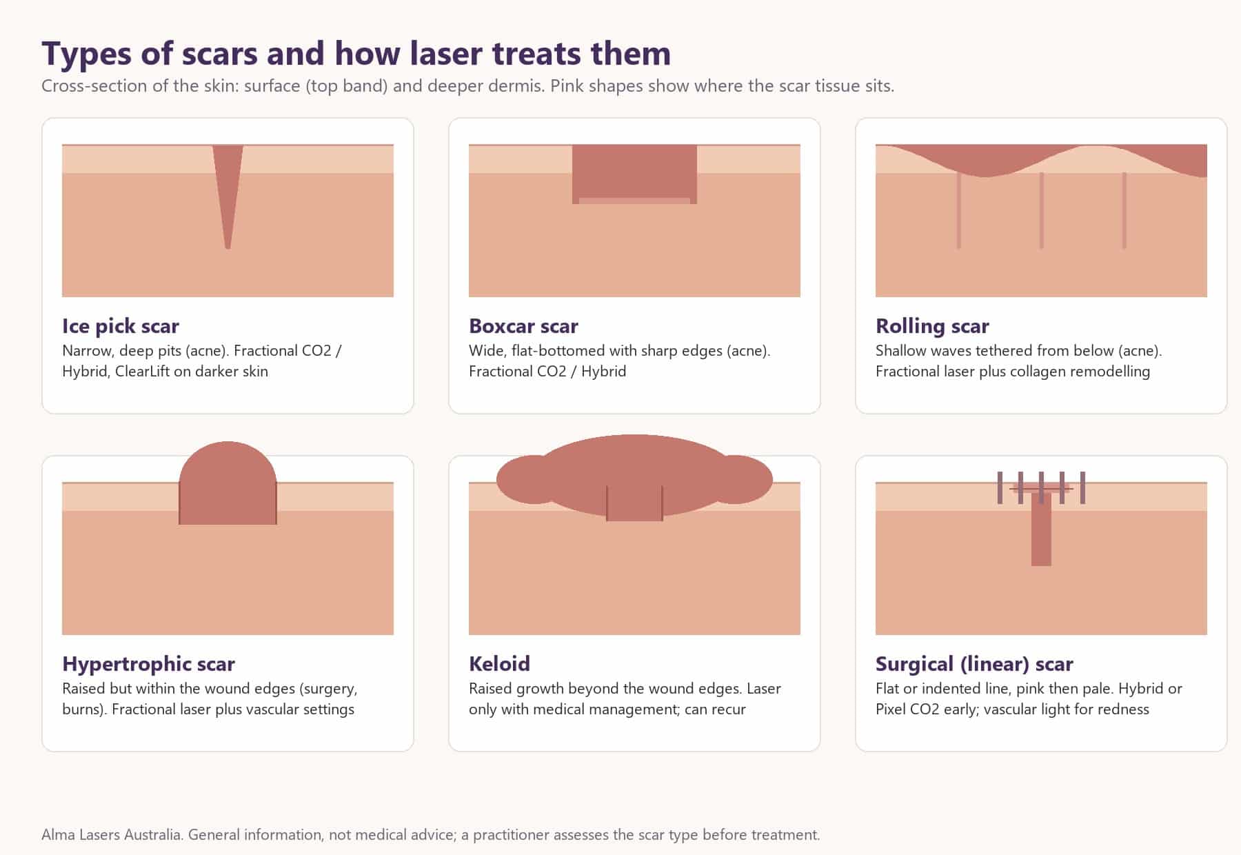 Types of scars in cross-section: ice pick, boxcar, rolling, hypertrophic, keloid and surgical linear scars, with the laser approach for each